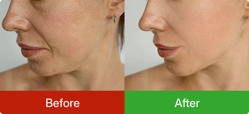 Before and after comparison of a woman's face with visible skin texture differences.