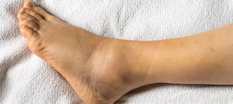 Foot with visible hair on a white towel