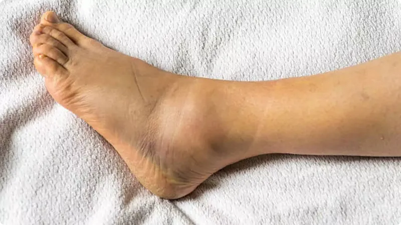Foot with a visible corn on a white towel
